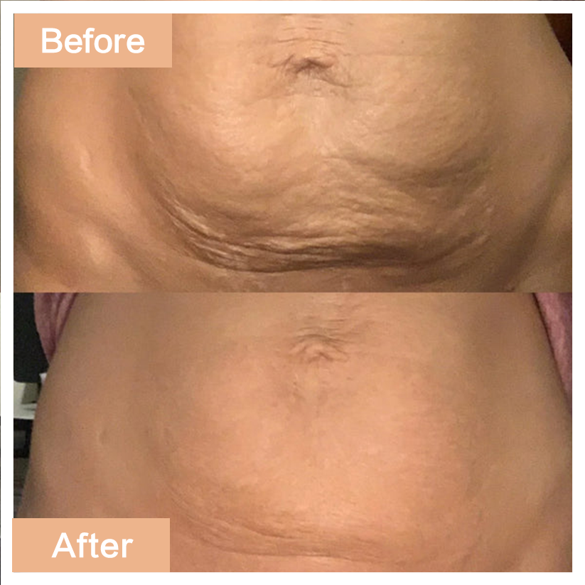 Anti-Cellulite Elixir