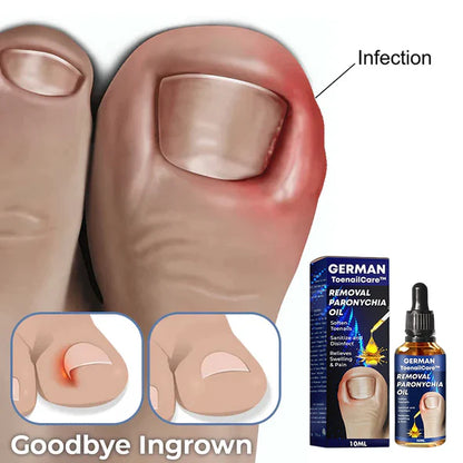 Ateticime Removal Paronychia