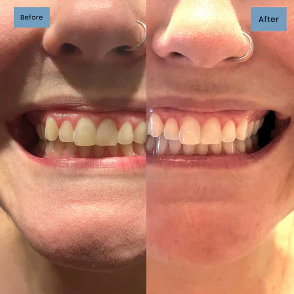 🦷Niacinamide Whitening Toothpaste - For Healthier, Whiter Teeth!