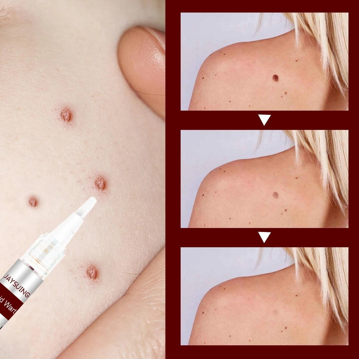 Best Sellers - Tags & Moles Remover——10 pcs (FREE SHIPPING)