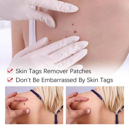 Best Sellers - Tags & Moles Remover——10 pcs (FREE SHIPPING)